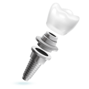 implante-dental-centro-de-saude-costa-lima-cs-clinica-madureira-rio-de-janeiro
