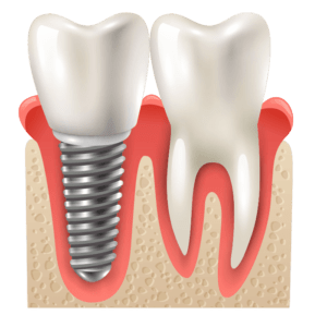 implante-dental-centro-de-saude-costa-lima-cs-clinica-madureira-rio-de-janeiro2