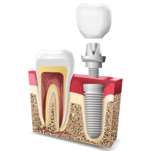 implante-dental-centro-de-saude-costa-lima-cs-clinica-madureira-rio-de-janeiro3