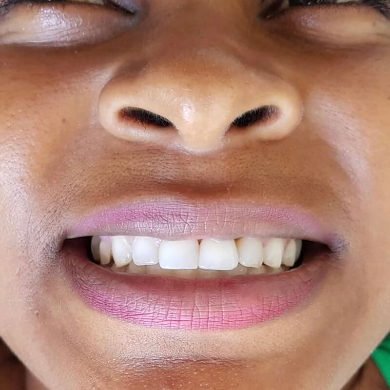 implantes-cs-costa-lima-centro-de-saude-implante-dental-madureira-rio-de-janeiro-antes-e-depois-4