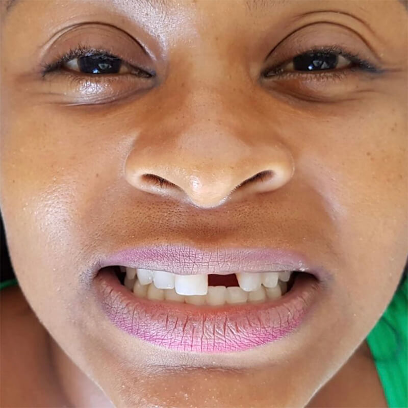 implantes-cs-costa-lima-centro-de-saude-implante-dental-madureira-rio-de-janeiro-antes-e-depois-5