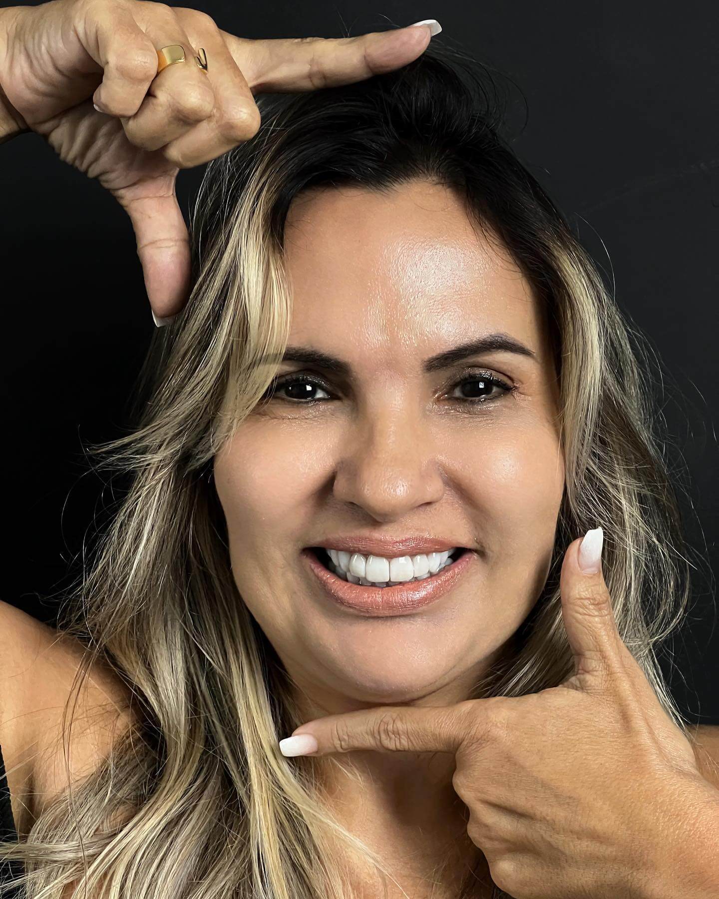 facetas-sorrios-clientes-dentista-michelle-cs-costa-lima-centro-de-saude-madureira-clinica-implante-dental-rio-de-janeiro-11