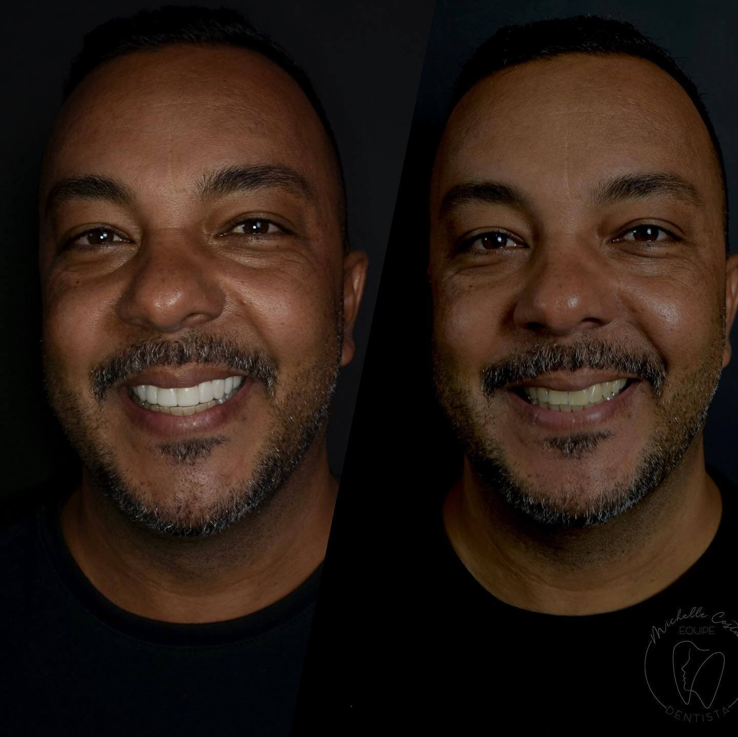 facetas-sorrios-clientes-dentista-michelle-cs-costa-lima-centro-de-saude-madureira-clinica-implante-dental-rio-de-janeiro-12