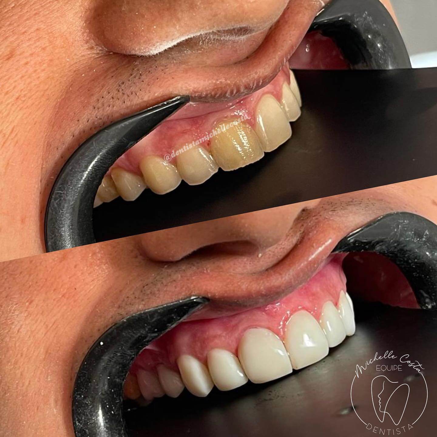 facetas-sorrios-clientes-dentista-michelle-cs-costa-lima-centro-de-saude-madureira-clinica-implante-dental-rio-de-janeiro-13