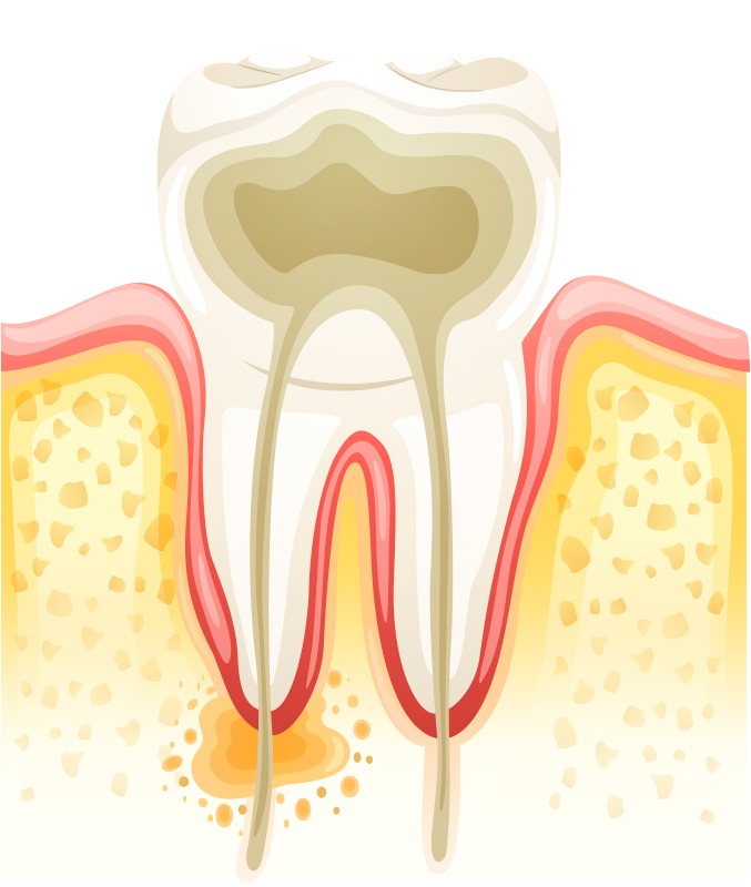 Polpa do dente danificada por uma cárie profunda